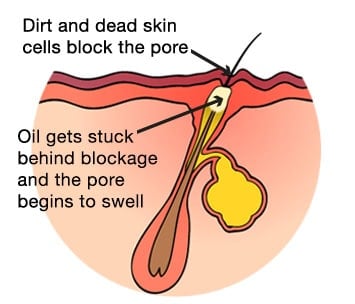 diagram of a pore clogged with oil spot forming